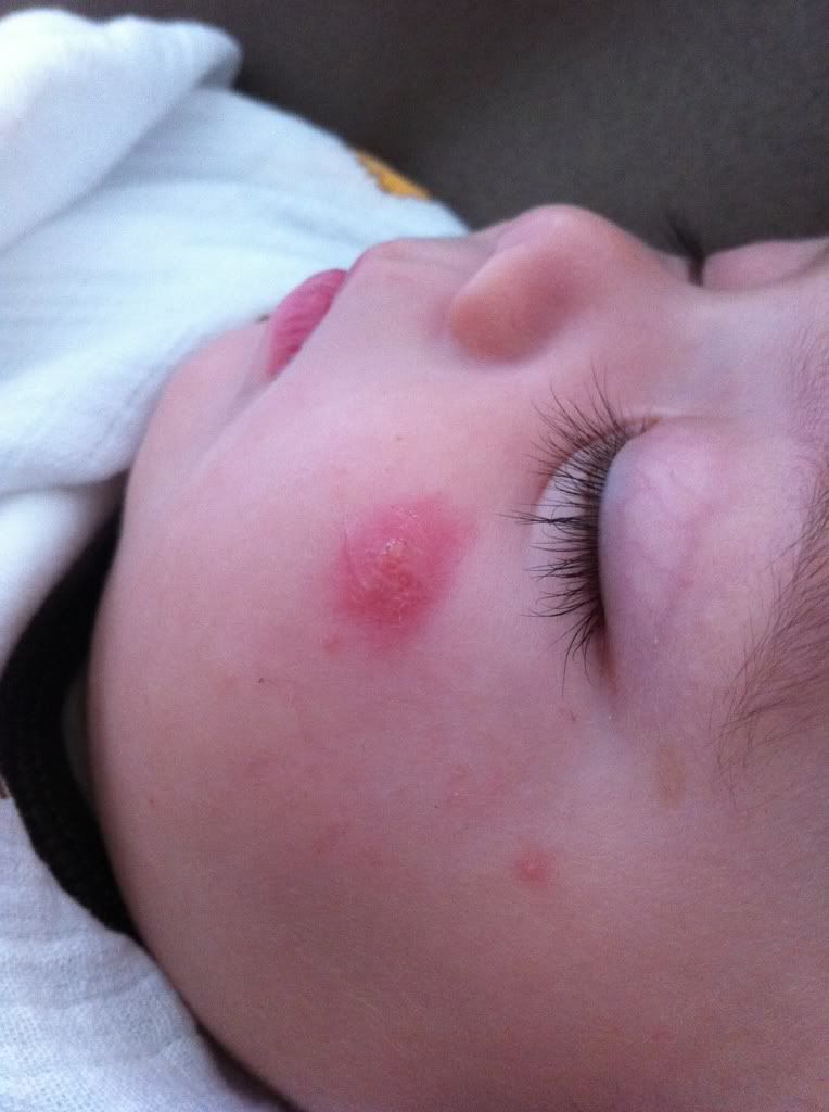 is-this-a-pimple-or-bug-bite-babycenter