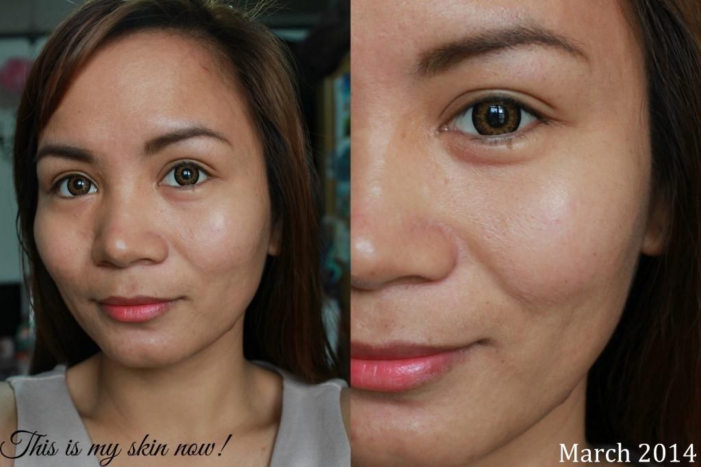 Real Asian Beauty: How to get rid of Acne Scars - PMD Review