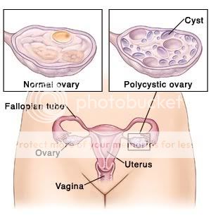 what is polycystic ovarian syndrome